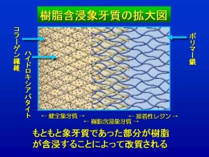 樹脂含浸象牙質の拡大図