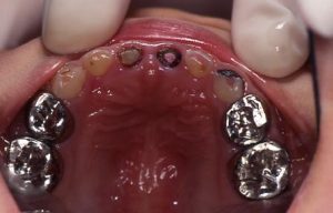 ３歳児短期間に急性齲蝕が発生した１