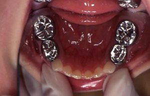 ３歳児短期間に急性齲蝕が発生した２