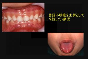 言語不明瞭を主訴として来院した５歳児