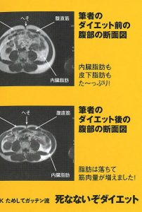 腹部断面のＭＲＩ写真