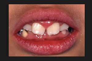 口呼吸性の歯肉炎