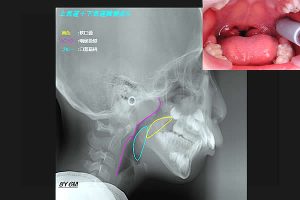 鼻閉のため口呼吸をしている男児のＸ線側貌セファロ写真
