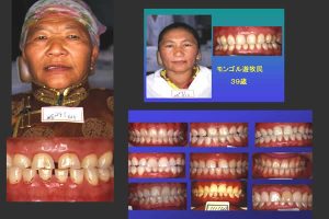 モンゴル遊牧民の前歯