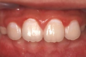 小学校２年生の前歯