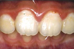 小学校２年生の前歯（初診時）