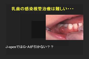 歯肉膿瘍や瘻孔