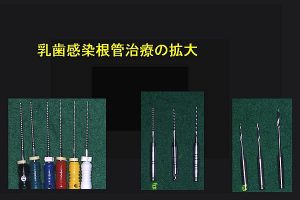 乳歯感染根管治療の拡大