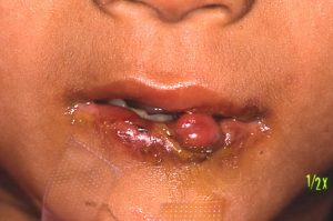 咬反射のため口唇を咬みちぎった児