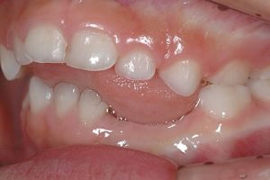 下顎左側ＡＢＣの欠損