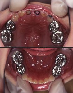 処置終了後の口腔内写真