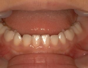 過蓋咬合のため、下顎前歯が舌側へ傾斜している