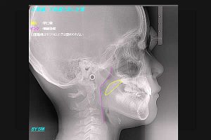 扁桃腺が腫れている子ども達のＸ線側貌セファロ写真