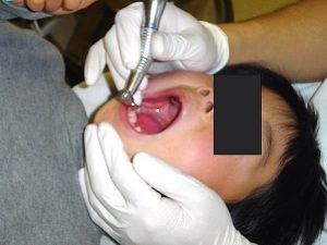 歯面の研磨（ＰＭＴＣ）